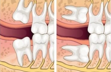 Can I Keep My Wisdom Tooth?