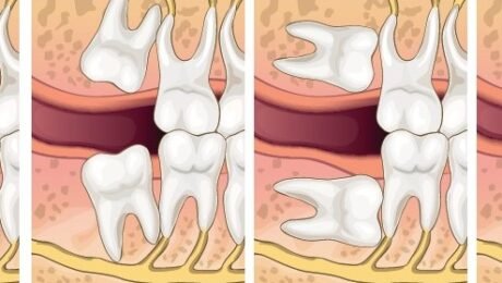 Can I Keep My Wisdom Tooth?