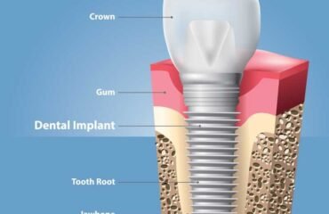 Dental Implant