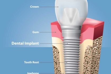 Dental Implant Dental Implant