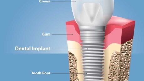 Dental Implant Dental Implant