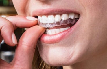 Can I Wear Braces as an Adult?