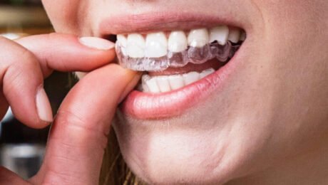 Can I Wear Braces as an Adult?