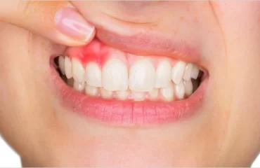 Mouth Ulcers