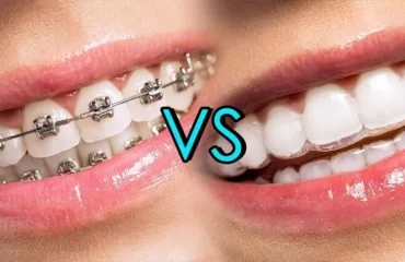 Dental Braces Vs Clear Aligners