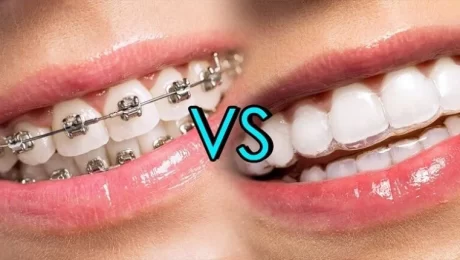 Dental Braces Vs Clear Aligners