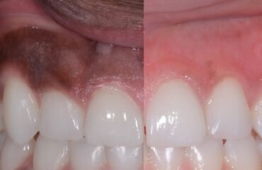 Gum Depigmentation