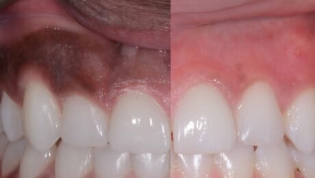Gum Depigmentation
