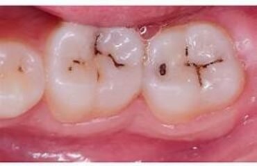 How Do I Know if I Have a Cavity?