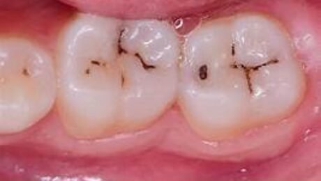 How Do I Know if I Have a Cavity?