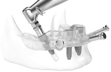 Digital Dental Implant Digital Dental Implant