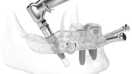 Digital Dental Implant Digital Dental Implant