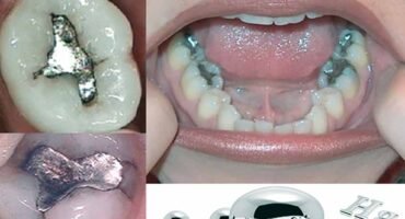 mercury-toxicity-dental-mercury-fillings