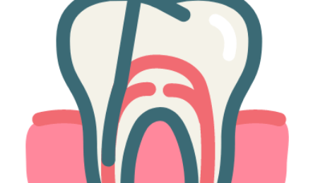 Root Canal Treatment in GK2