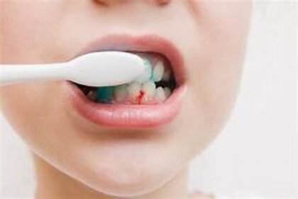 Bleeding gums