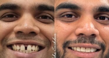 smile makeover