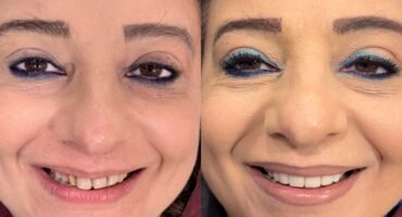 Smile Makeover Smile Makeover