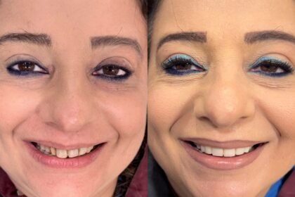 Smile Makeover