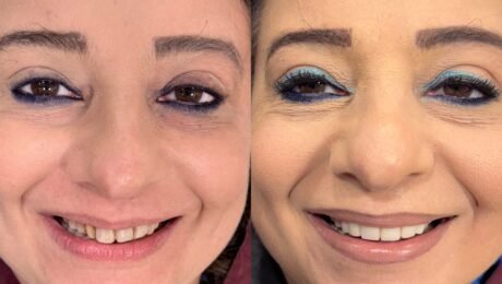 Smile Makeover